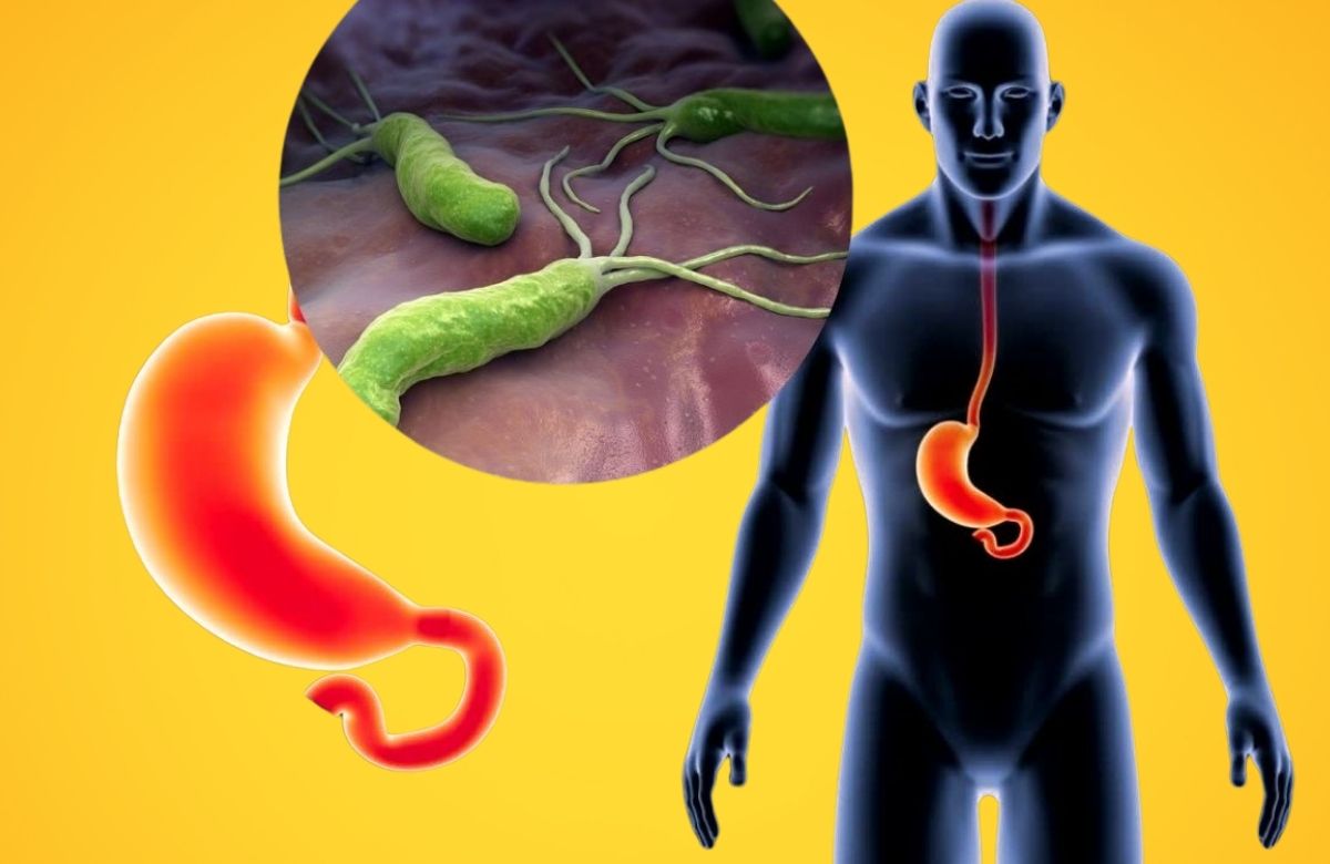 Infekcija želuca uzrokovana bakterijom može izazvati čir, gastritis i probleme sa varenjem.